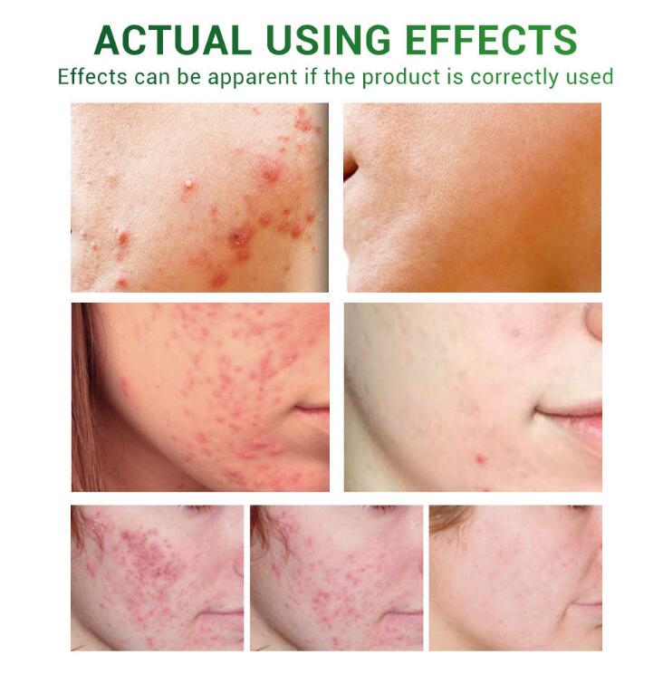 Acne Treatment